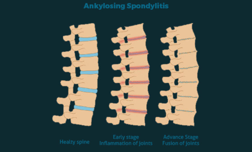 Ankylosing Spondylitis