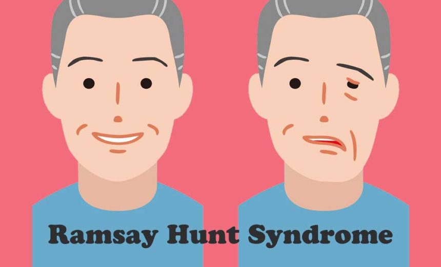 ramsay hunt syndrome